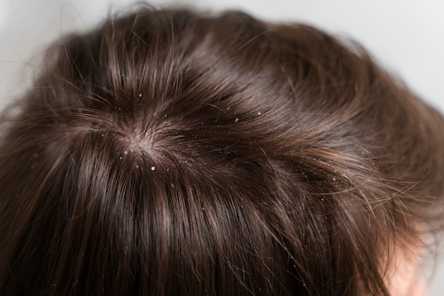 Banishing Dandruff: Simple and Natural Solutions That Work